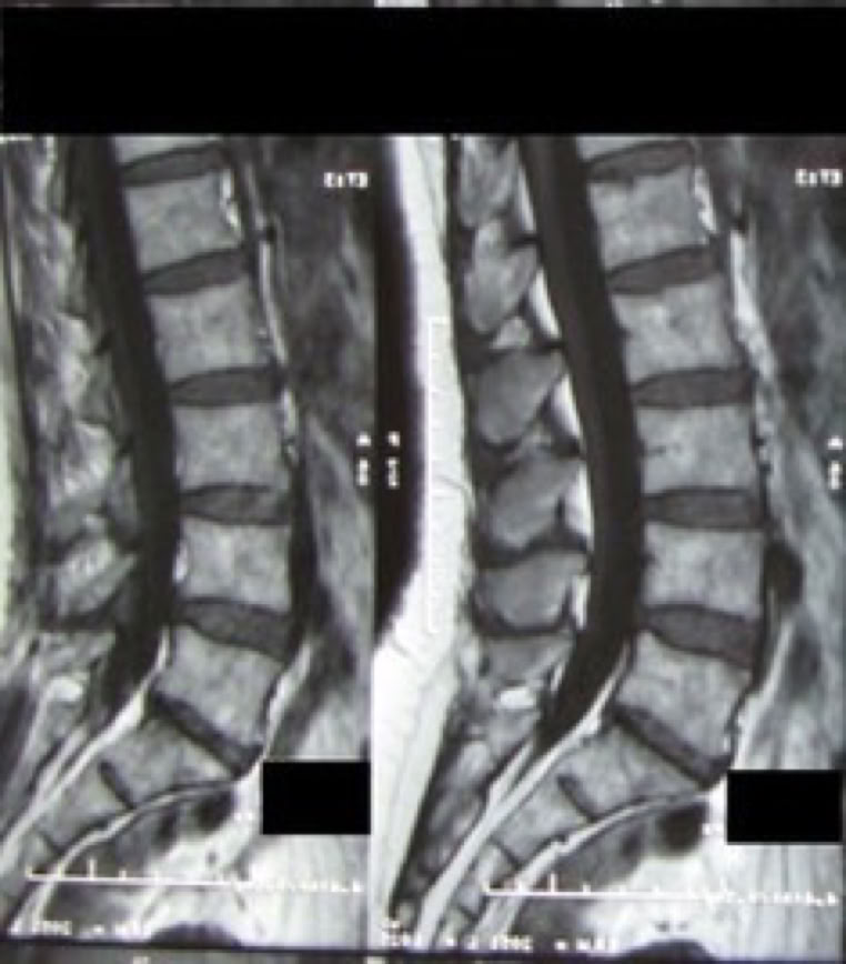 MRI of disc herniation