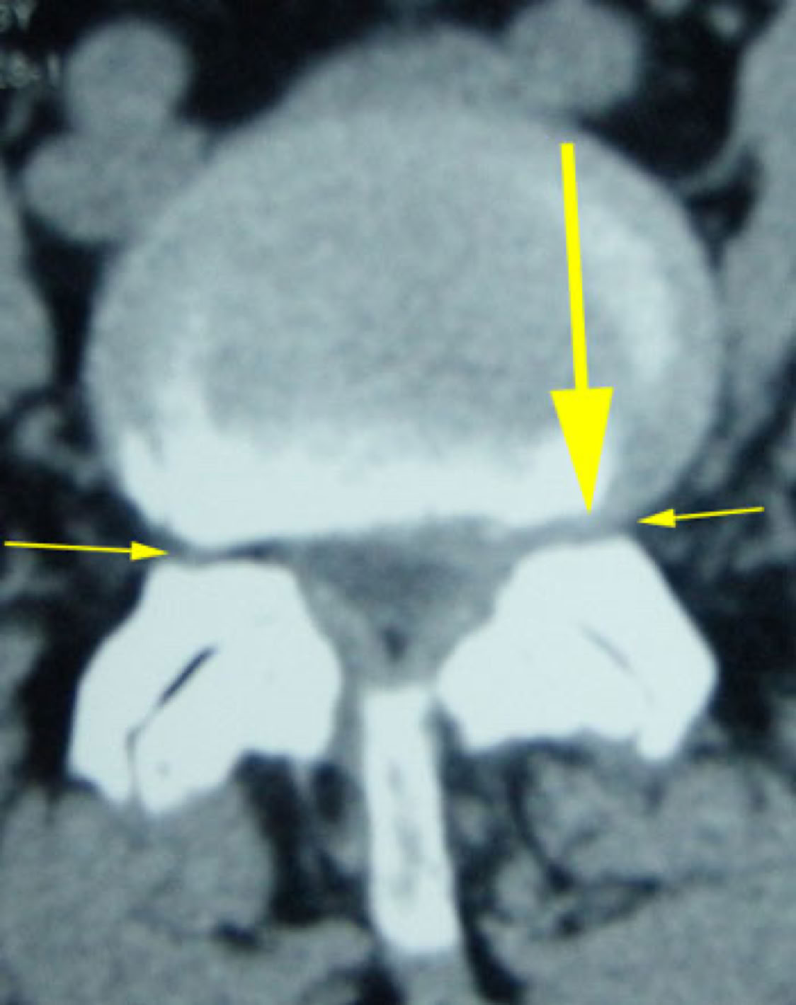 spinal canal stenosis on imaging