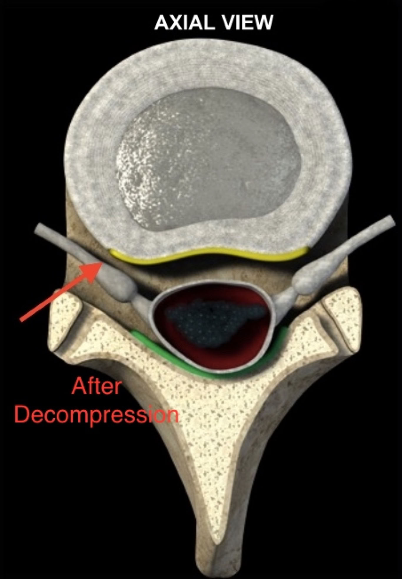 Disc gerniation after non-surgical spinal decompression