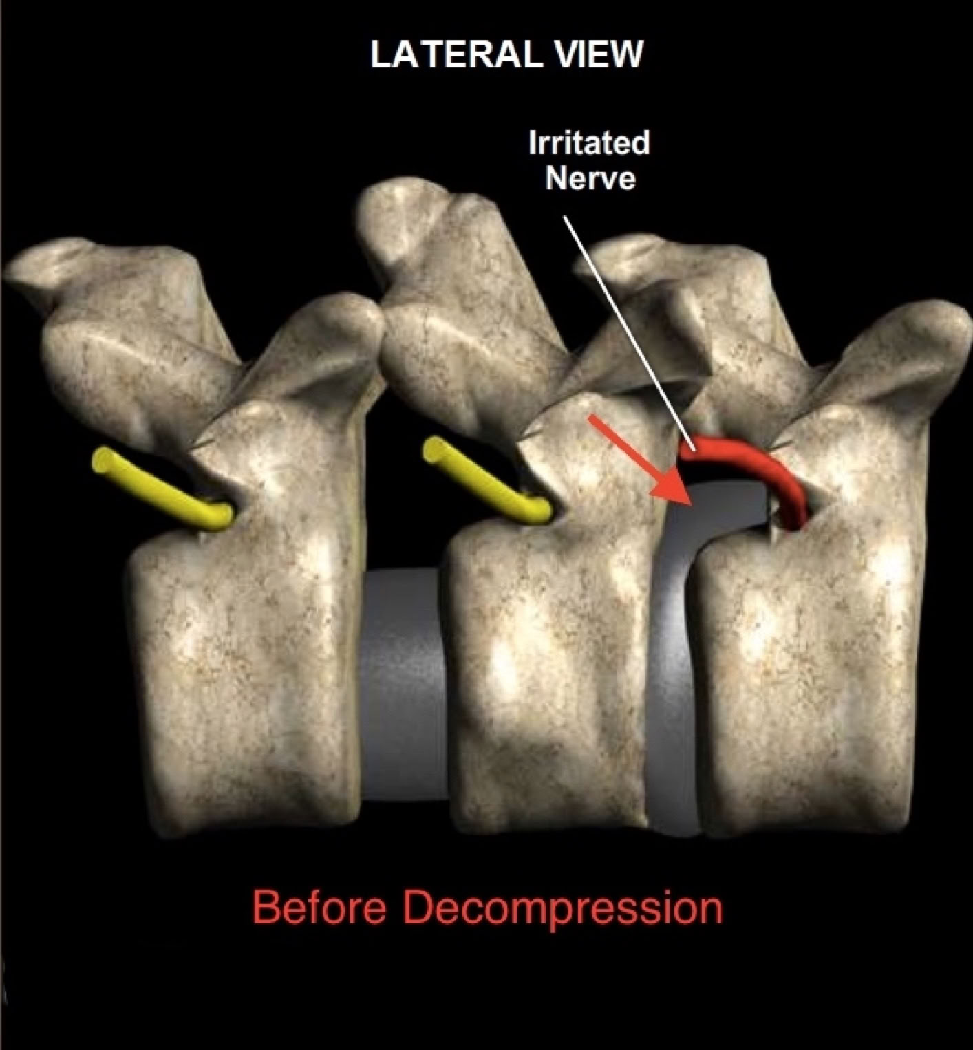 Disc herniation before non-surgical spinal decompression