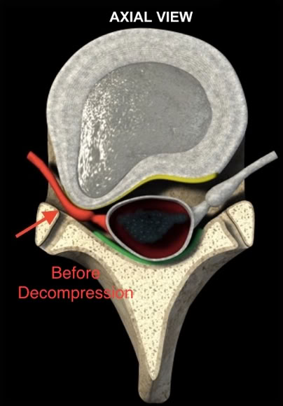 disc herniation compressing the nerve