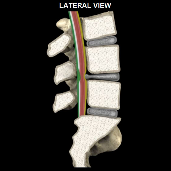 spinal stenosis picture