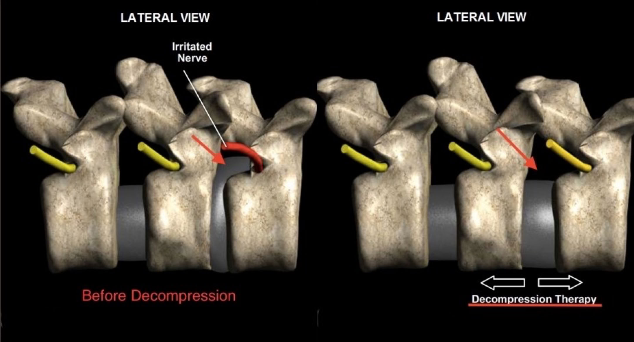 Decompression Before and After in Non-Surgical Spinal Decompression