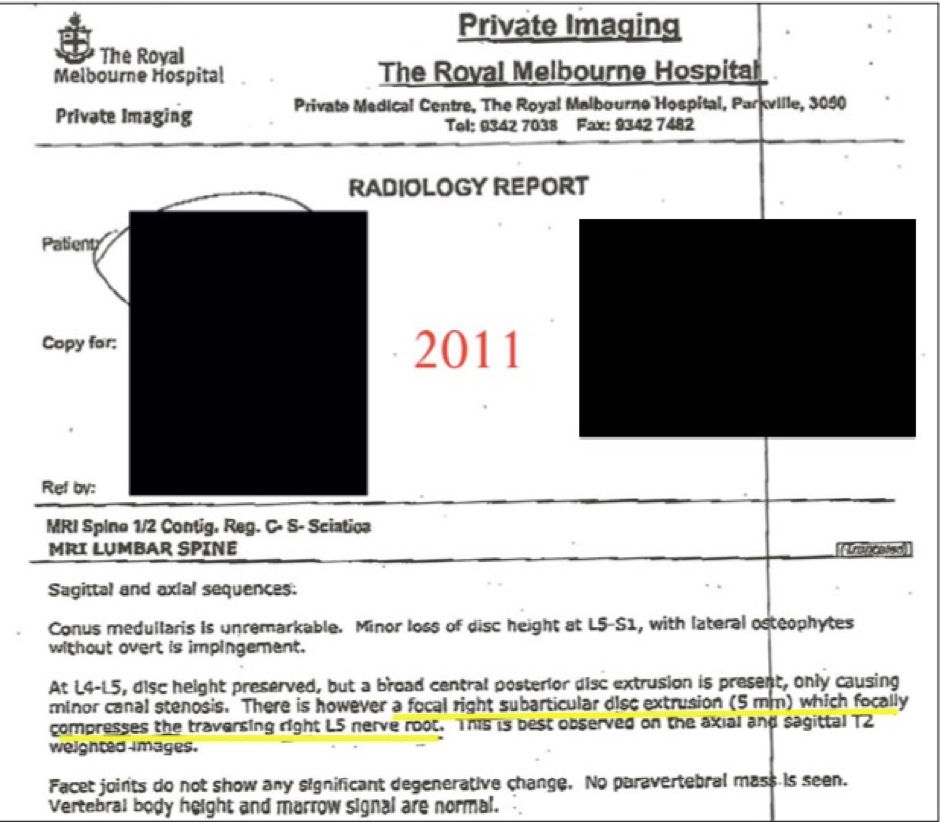 MRI reports before and after spinal decompression