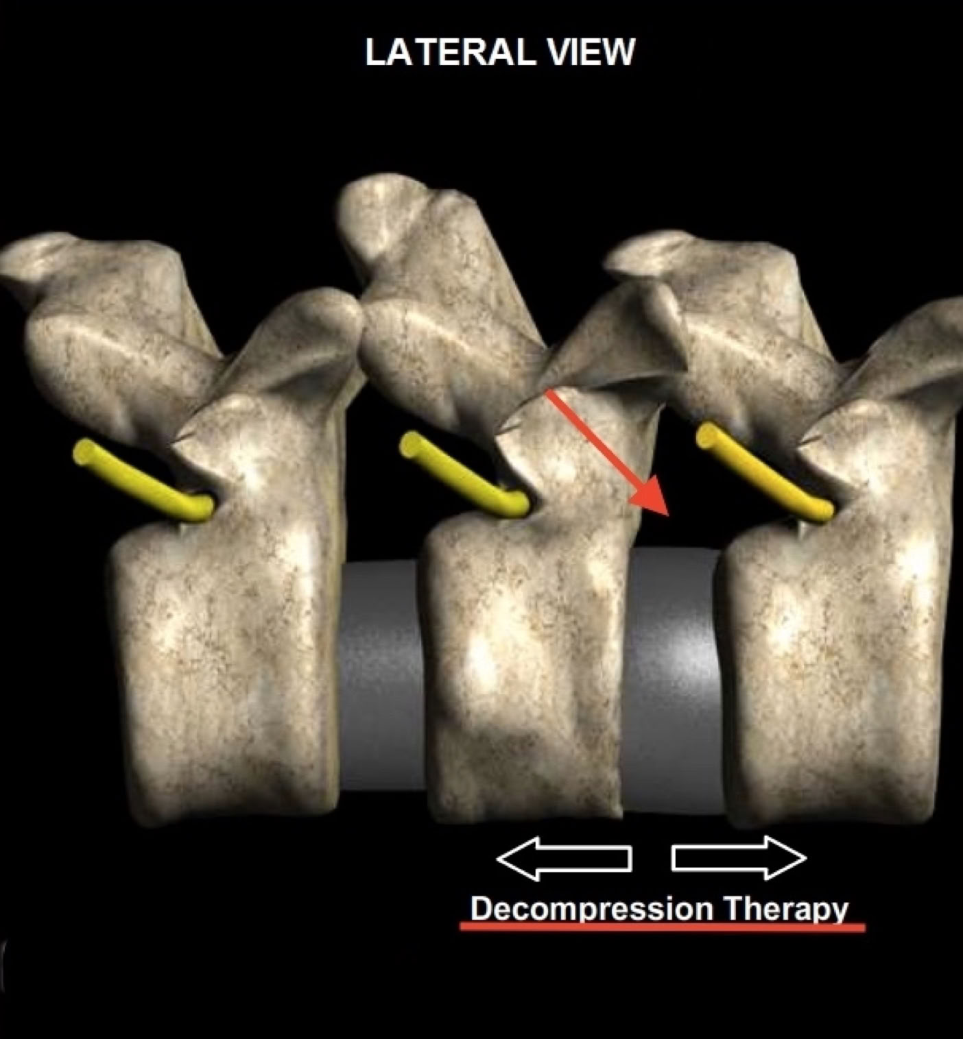 Disc herniation after non-surgical spinal decompression