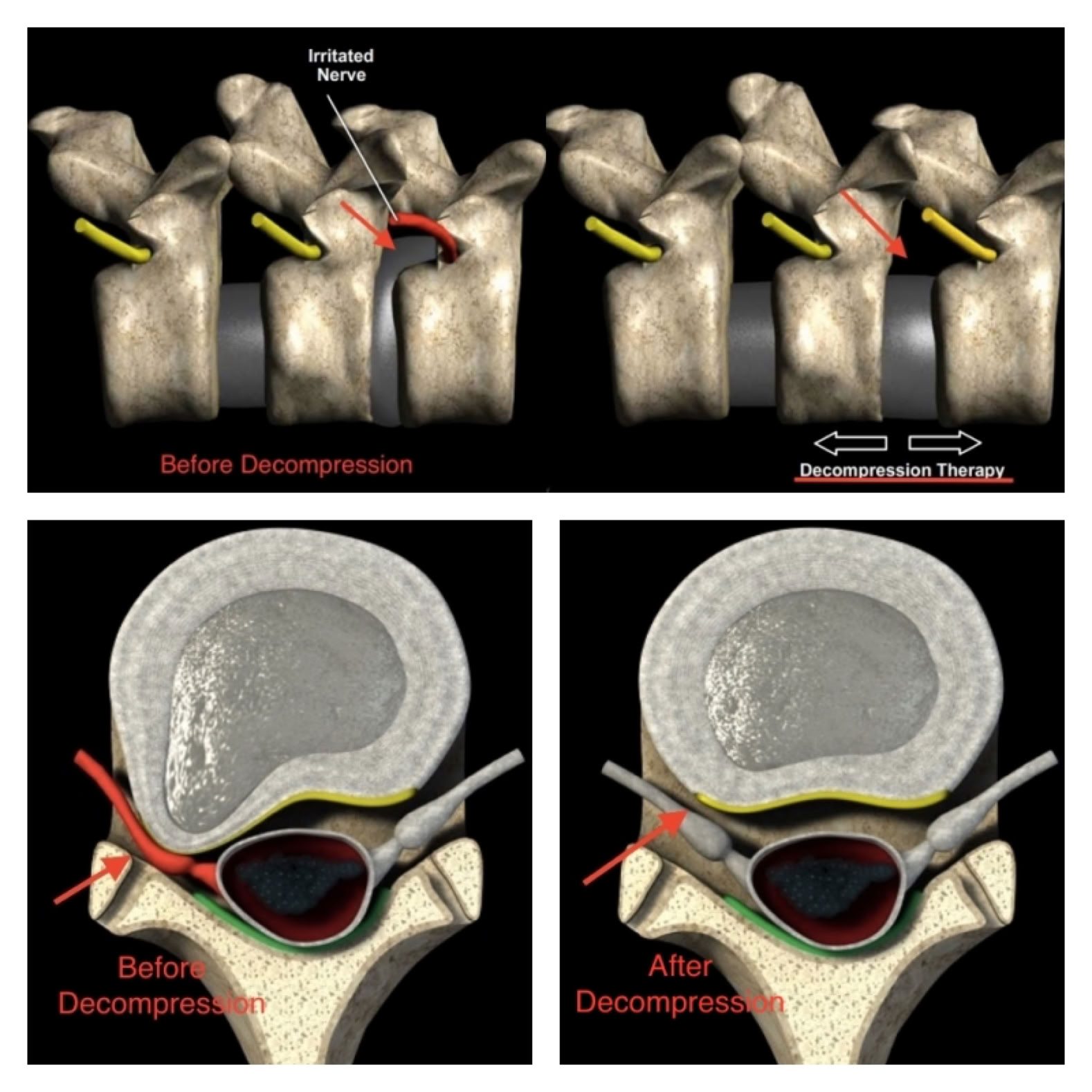 Cox technic treatment before and after decompressing the disc