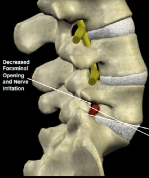 facet syndrome picture