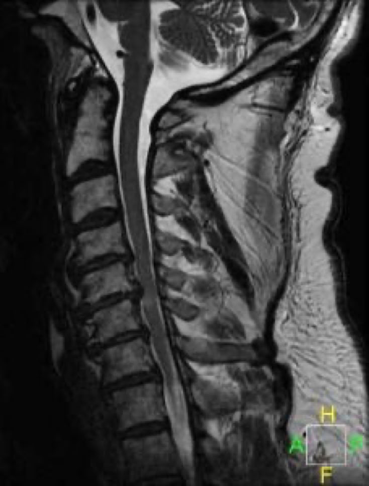 cervical spine stenosis